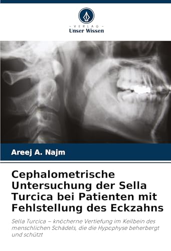 Cephalometrische Untersuchung der Sella Turcica bei Patienten mit Fehlstellung des Eckzahns: Sella Turcica - knöcherne Vertiefung im Keilbein des ... die die Hypophyse beherbergt und schützt von Verlag Unser Wissen