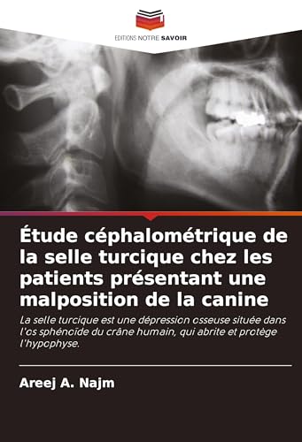 Étude céphalométrique de la selle turcique chez les patients présentant une malposition de la canine: La selle turcique est une dépression osseuse ... humain, qui abrite et protège l'hypophyse.