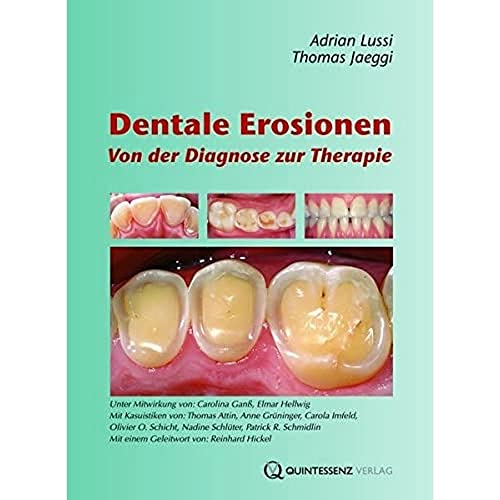 Dentale Erosionen: Von der Diagnose zur Therapie