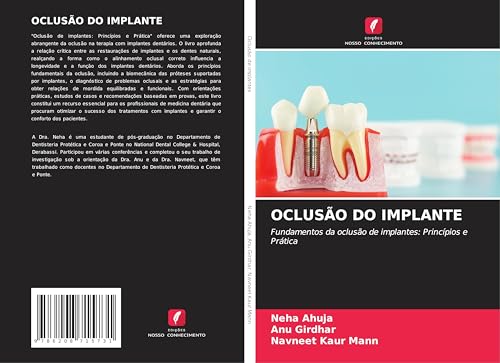 OCLUSÃO DO IMPLANTE: Fundamentos da oclusão de implantes: Princípios e Prática von Edições Nosso Conhecimento