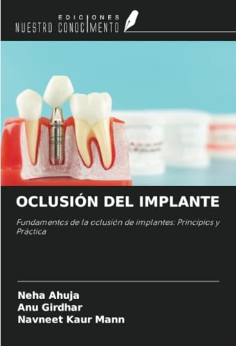 OCLUSIÓN DEL IMPLANTE: Fundamentos de la oclusión de implantes: Principios y Práctica von Ediciones Nuestro Conocimiento
