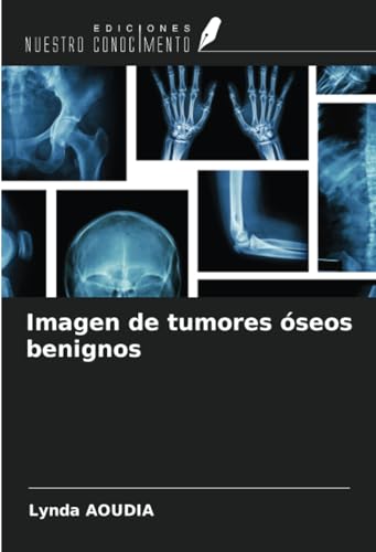 Imagen de tumores óseos benignos von Ediciones Nuestro Conocimiento