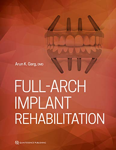 Full-Arch Implant Rehabilitation