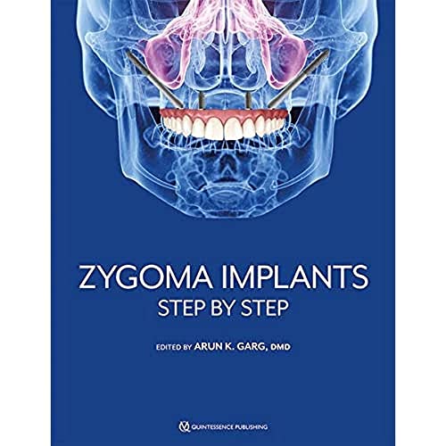 Zygoma Implants: Step by Step