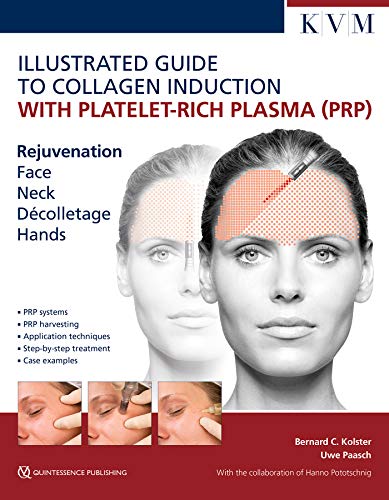 Illustrated Guide to Collagen Induction with Platelet-Rich Plasma (PRP): Rejuvenation Face | Neck | Décolleté | Hands von KVM - Der Medizinverlag