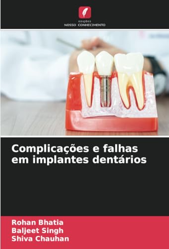Complicações e falhas em implantes dentários von Edições Nosso Conhecimento