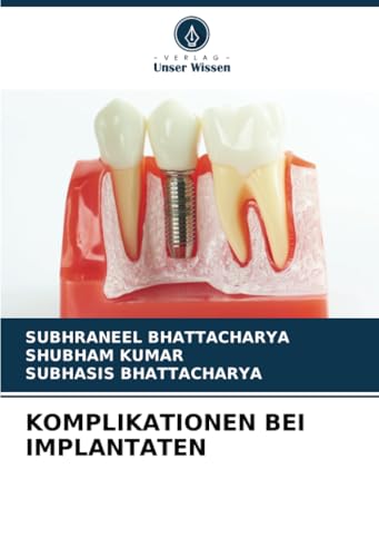 KOMPLIKATIONEN BEI IMPLANTATEN: DE von Verlag Unser Wissen