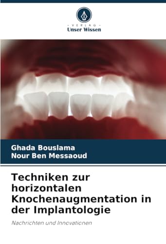 Techniken zur horizontalen Knochenaugmentation in der Implantologie: Nachrichten und Innovationen von Verlag Unser Wissen