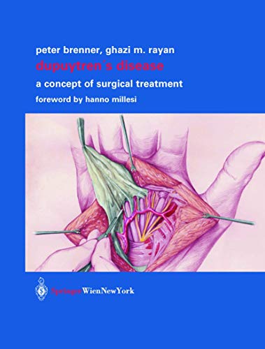 Dupuytren’s Disease: A Concept of Surgical Treatment