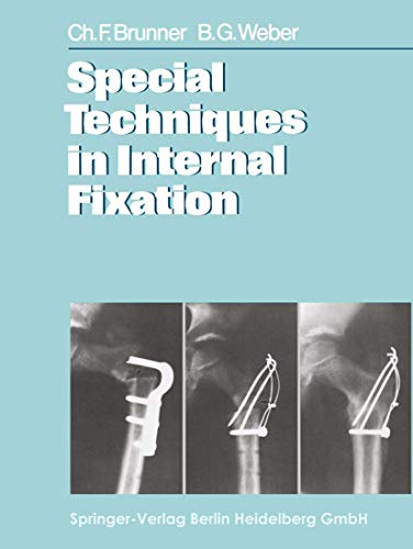 Special Techniques in Internal Fixation von Springer