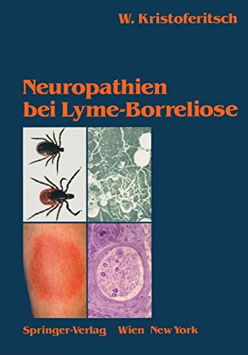 Neuropathien bei Lyme-Borreliose von Springer