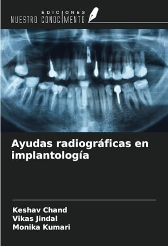 Ayudas radiográficas en implantología von Ediciones Nuestro Conocimiento