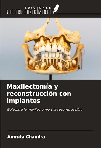 Maxilectomía y reconstrucción con implantes: Guía para la maxilectomía y la reconstrucción. von Ediciones Nuestro Conocimiento