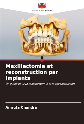 Maxillectomie et reconstruction par implants: Un guide pour la maxillectomie et la reconstruction. von Editions Notre Savoir