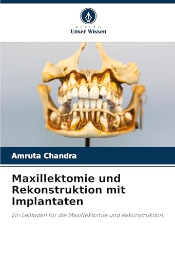 Maxillektomie und Rekonstruktion mit Implantaten: Ein Leitfaden für die Maxillektomie und Rekonstruktion. von Verlag Unser Wissen