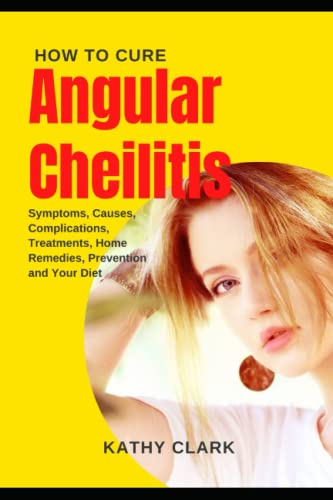 Angular Cheilitis: How To Cure Angular Cheilitis, Symptoms, Causes, Complications, Treatments, Home Remedies, Prevention and Your Diet