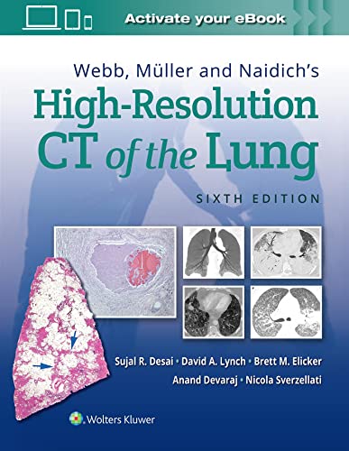 Webb, Muller and Naidich's High Resolution of Lung CT von LWW