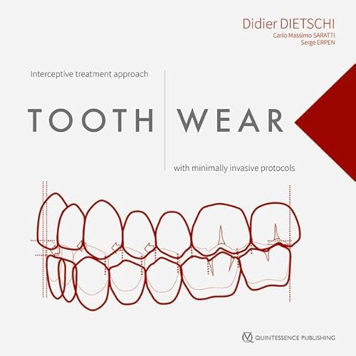 Tooth Wear: Interceptive treatment approach with minimally invasive protocols