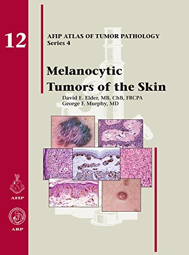 Melanocytic Tumors of the Skin (Afip Atlas of Tumor Pathology, Fourth Series Fascicle, Band 12)
