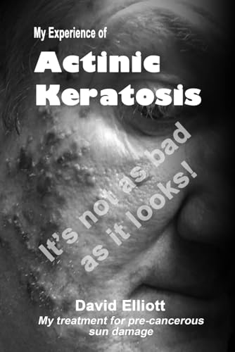 My experience of Actinic Keratosis: How I was affected by pre-cancerous sun damage (leading to Actinic Keratosis and possible skin cancer on the face) along with the skin care treatment received von Independently published