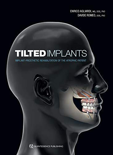 Tilted Implants: Implant-Prosthetic Rehabilitation of the Atrophic Patient: Implant-Prosethetic Rehabilitation of the Atrophic Patient von Quintessence Publishing (IL)