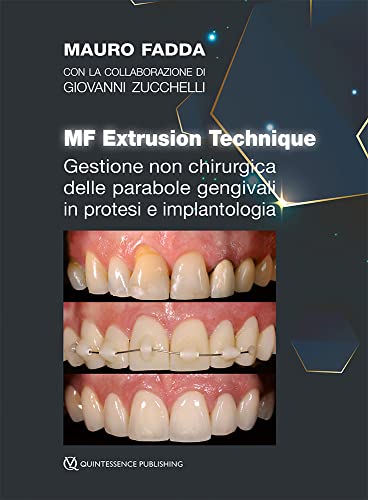 Gestione non chirurgica delle parabole gengivali in protesi e implantologia. MF extrusion technique Gestione non chirurgica delle parabole gengivali in protesi e implantologia. MF extrusion technique von Quintessenza