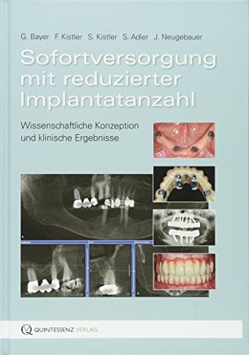 Sofortversorgung mit reduzierter Implantatanzahl: Wissenschaftliche Konzeption und klinische Ergebnisse von Quintessenz, Berlin