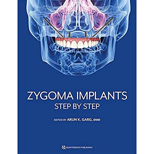 Zygoma Implants: Step by Step von Quintessence Publishing Co Inc