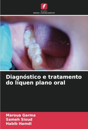 Diagnóstico e tratamento do líquen plano oral: DE von Edições Nosso Conhecimento