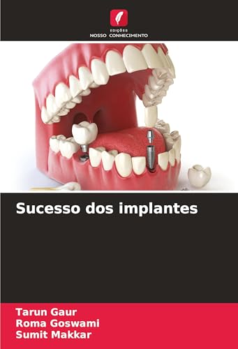 Sucesso dos implantes: DE von Edições Nosso Conhecimento
