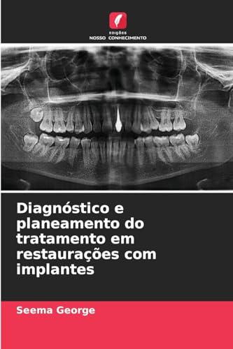 Diagnóstico e planeamento do tratamento em restaurações com implantes: DE von Edições Nosso Conhecimento
