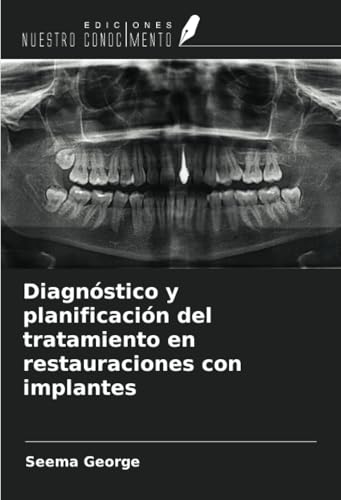 Diagnóstico y planificación del tratamiento en restauraciones con implantes von Ediciones Nuestro Conocimiento