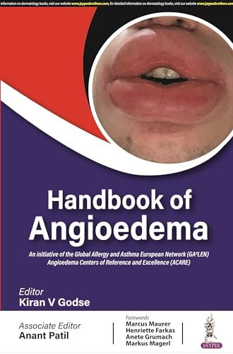 Handbook of Angioedema von Jaypee Brothers Medical Publishers