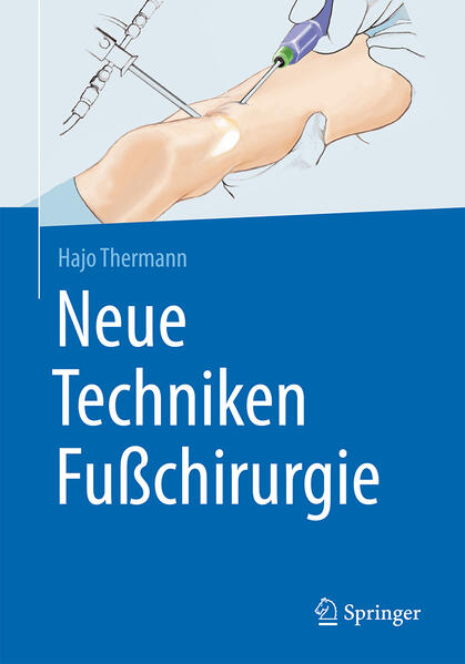 Neue Techniken Fußchirurgie von Springer-Verlag GmbH