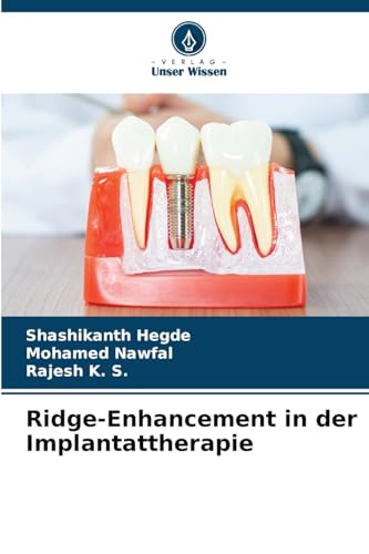 Ridge-Enhancement in der Implantattherapie von Verlag Unser Wissen