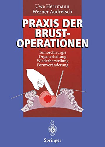 Praxis der Brustoperationen: Tumorchirurgie — Organerhaltung — Wiederherstellung — Formveränderung von Springer