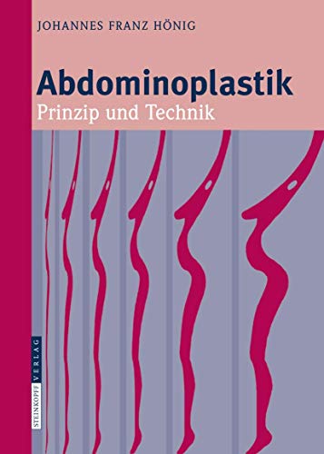Abdominoplastik: Prinzip und Technik
