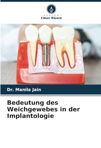 Bedeutung des Weichgewebes in der Implantologie von Verlag Unser Wissen