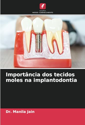 Importância dos tecidos moles na implantodontia: DE von Edições Nosso Conhecimento