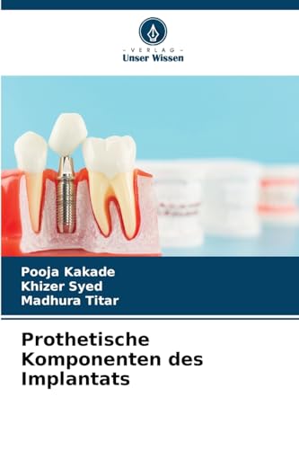 Prothetische Komponenten des Implantats von Verlag Unser Wissen