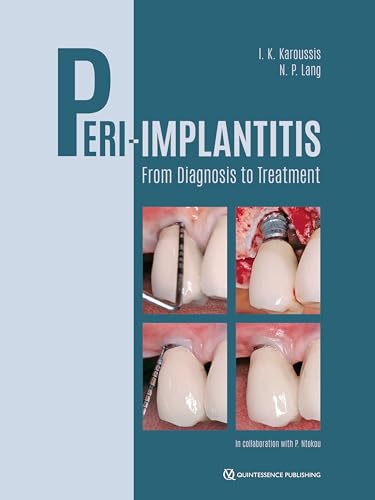 Peri-Implantitis: From Diagnosis to Treatment Peri-Implantitis: From Diagnosis to Treatment von Quintessence Publishing