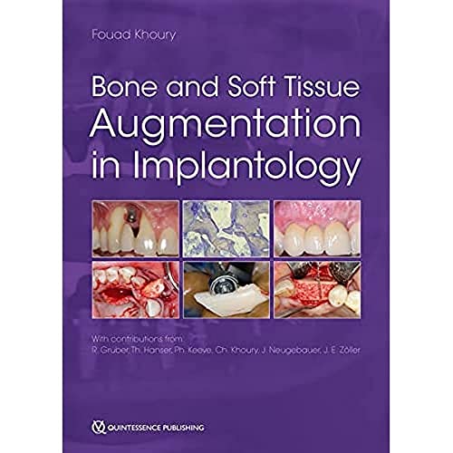 Bone and Soft Tissue Augmentation in Implantology von Quintessence Publishing