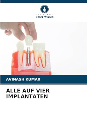 ALLE AUF VIER IMPLANTATEN: DE von Verlag Unser Wissen
