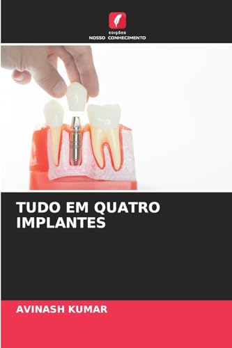 TUDO EM QUATRO IMPLANTES: DE von Edições Nosso Conhecimento
