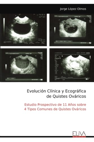Evolución Clínica y Ecográfica de Quistes Ováricos: Estudio Prospectivo de 11 Años sobre 4 Tipos Comunes de Quistes Ováricos von Eliva Press