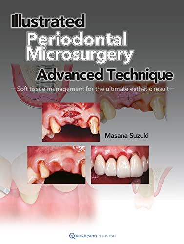 Illustrated Advanced Technique of Periodontal Microsurgery: Soft tissue management for the ultimate esthetic result: Advanced Technique Soft Tissue Management for the Ultimate Esthetic Result Illustrated Advanced Technique of Periodontal Microsurgery: Soft tissue management for the ultimate esthetic result: Advanced Technique Soft Tissue Management for the Ultimate Esthetic Result