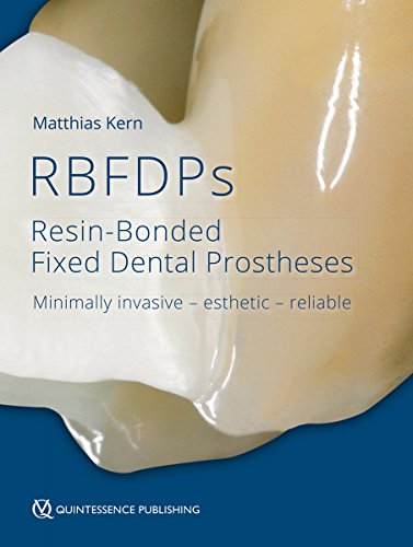 RBFDPs - Resin-Bonded Fixed Dental Prostheses von Quintessence Publishing