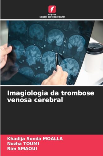 Imagiologia da trombose venosa cerebral von Edições Nosso Conhecimento