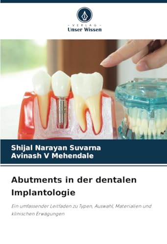 Abutments in der dentalen Implantologie: Ein umfassender Leitfaden zu Typen, Auswahl, Materialien und klinischen Erwägungen von Verlag Unser Wissen