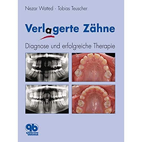 Verlagerte Zähne: Diagnose und erfolgreiche Therapie